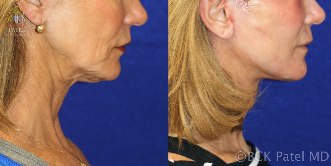 Facelift results before and after in a lady by Dr. Bhupendra C. K. Patel MD, best plastic surgeon Salt Lake City, Saint George, Utah