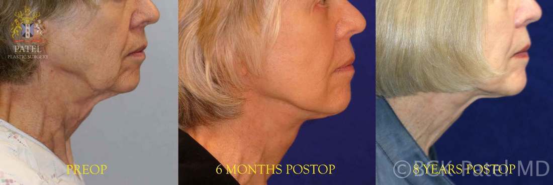 Photos to show how a well-performed facelift will give a marked improvement in the face. Dr. Bhupendra C. K. Patel MD