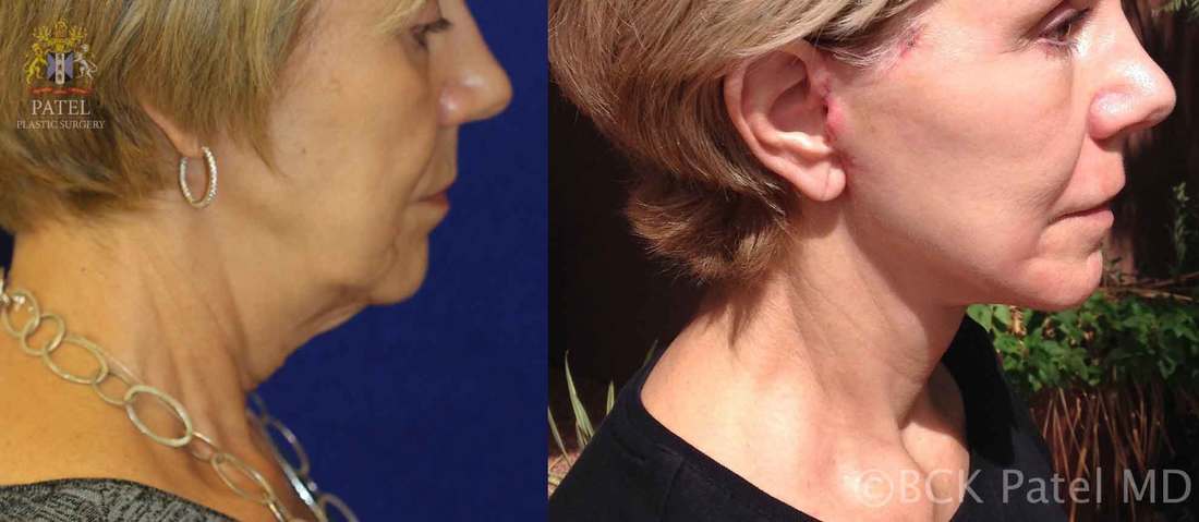 Lower facelift and necklift showing an improvement in the jowls as well as the neck by Dr. Bhupendra C. K. Patel MD of Salt Lake City, and Saint George, Utah