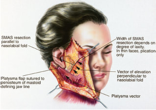 Anatomy of the face during a facelift