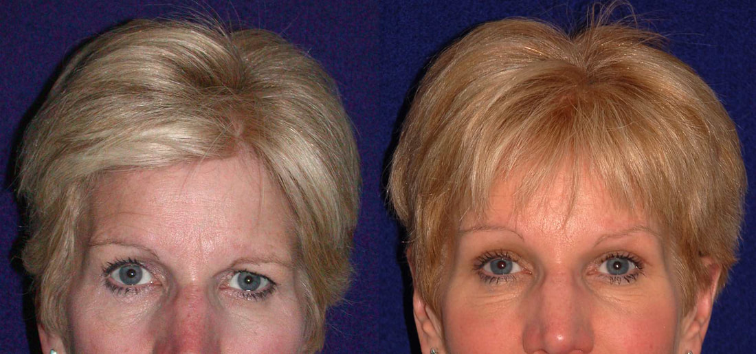Cosmetic brow lifts and upper and lower blepharoplasty in the presence of asymmetric brows from facial palsy repaired by Dr BCK Patel MD