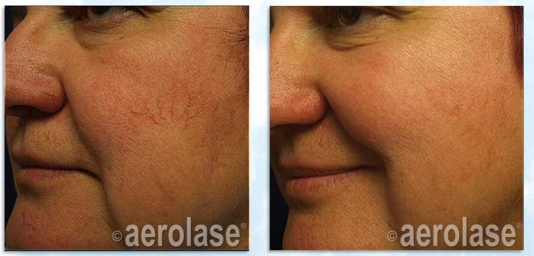 Treatment of facial veins with the Aerolase Neo laser Dr BCK Patel MD, FRCS Plastic Surgeon Salt Lake City and St George UtahPicture