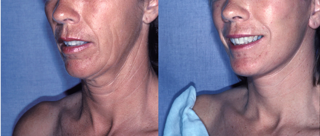 Facelift and necklift by Dr BCK Patel MD of Salt Lake City and St George Utah