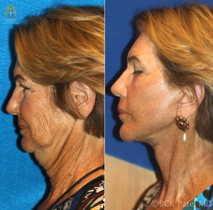 Advanced deep plane Facelift and neck lift together with use of nano fat grafts and lasers giving beautiful facelift and neck lift results by Dr. BCK Patel MD, FRCS of Salt Lake City and St. George, Utah