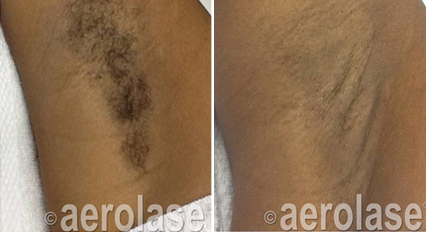 Hair removal with the Aerolase Neo Dr. BCK Patel, Plastic Surgeon, Salt Lake City and St George, UtahPicture