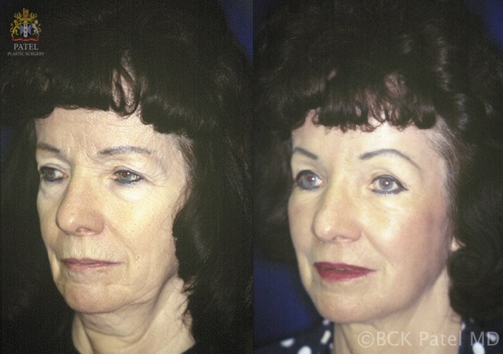 before after mid facelift surgery