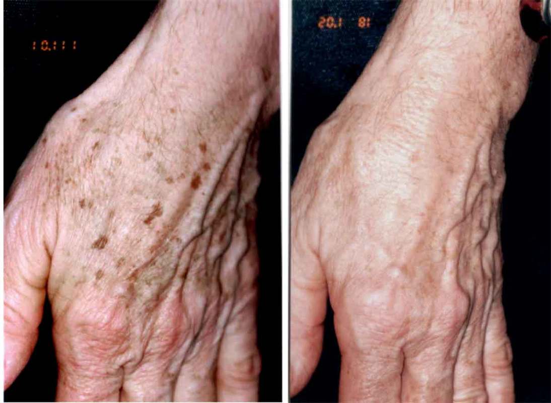 Treatment of aging hands with lasers to improve pigment spots and red spots by Dr. Bhupendra C. K. Patel MD of Salt Lake City and Saint George, Utah