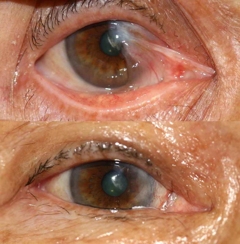 Dr. Bhupendra C. K. Patel MD of Salt Lake City and Saint George, utah treats growths on the eye called a pterygium (pterygia) with conjunctival grafts to improve dryness and redness of the eye