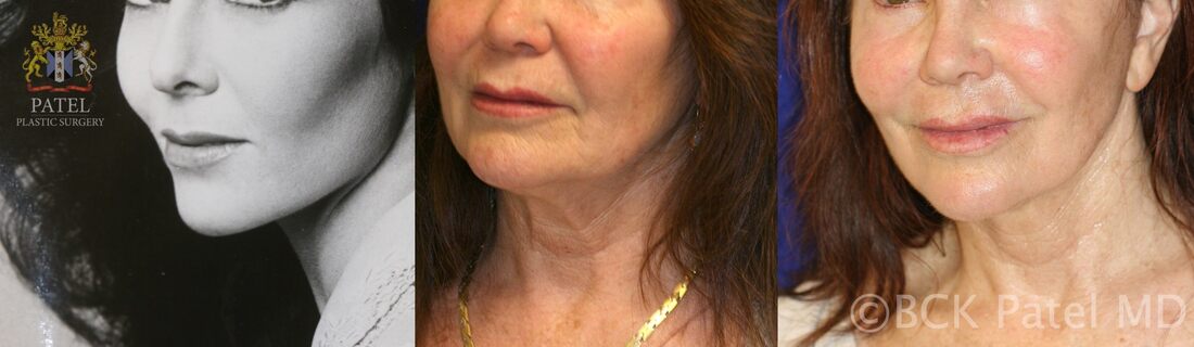 Lower facelift and necklift by Dr BCK Patel MD best plastic surgeon Salt Lake City and St George Utah