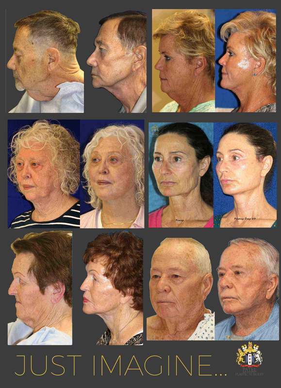 Facelift results in men and in women by Dr. Bhupendra C. K. Patel MD of Salt Lake City and Saint George, Utah. Best facelift surgeon Dr. Bhupendra C. K. Patel MD