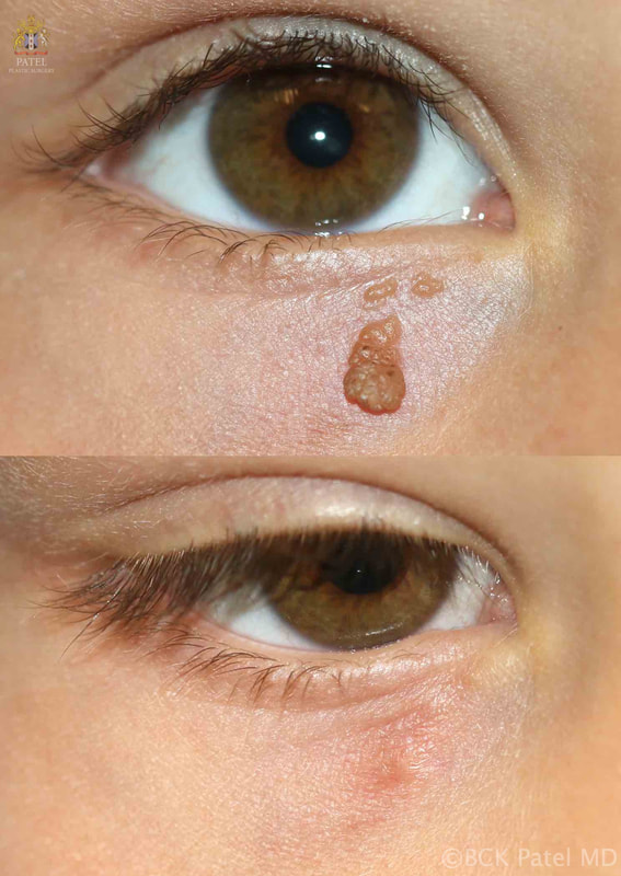 Laser removal of pigmented raised moles on the lower eyelid by Dr. BCK Patel MD, FRCS or Salt Lake City and St. George, Utah. Beautiful cosmetic mole removal