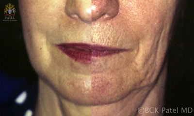 lips surgery comparision