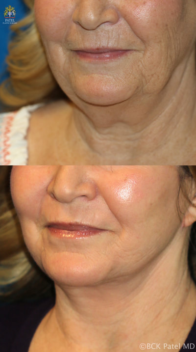 lips lines wrinkles treatment