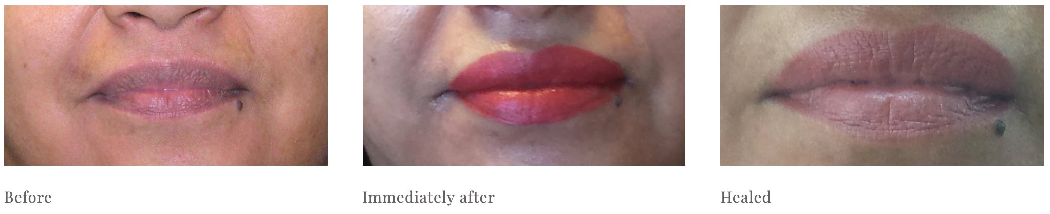 Photos show permanent lip makeup tattoo. BCK Patel MD, FRCS Professor Bhupendra C. K. Patel MD, FRCS