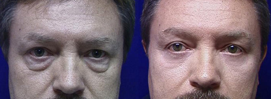 In men, the lower blepharoplasty must improve the bags and the deep grooves, as well as lighten dar circles and firm up lax eyelids: requires careful attention to detail. This gives beautiful, almost invisible results. 