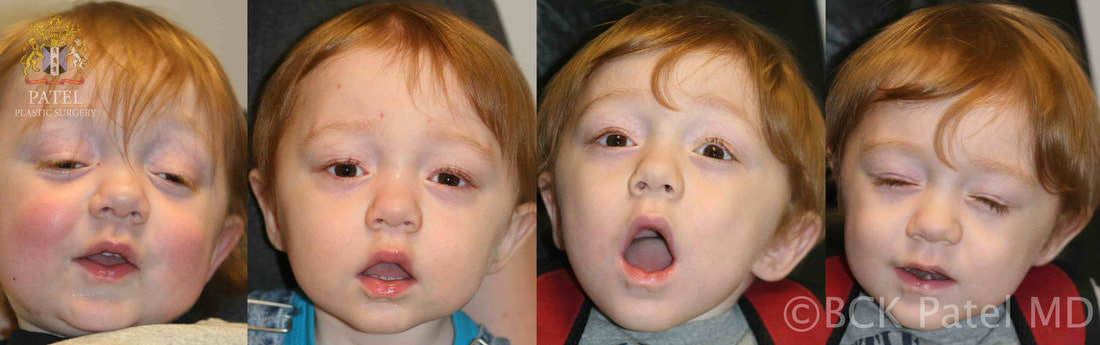 Severe ptosis in a child with myasthenia gravis treated with frontalis slings which allow the child to open the eyelids and also close them well enough to protect the corneas by Prof. BCK Patel MD, FRCS