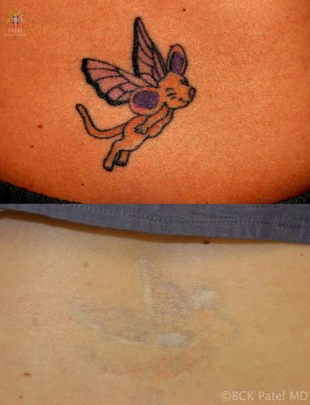 Laser tattoo imporvement in a tattoo containing red, green, orange and other colours: by Dr. Bhupendra Patel MD
