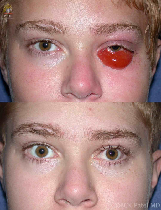Pre&post op photographs showing improvement of severe chemosis that occured after facial trauma