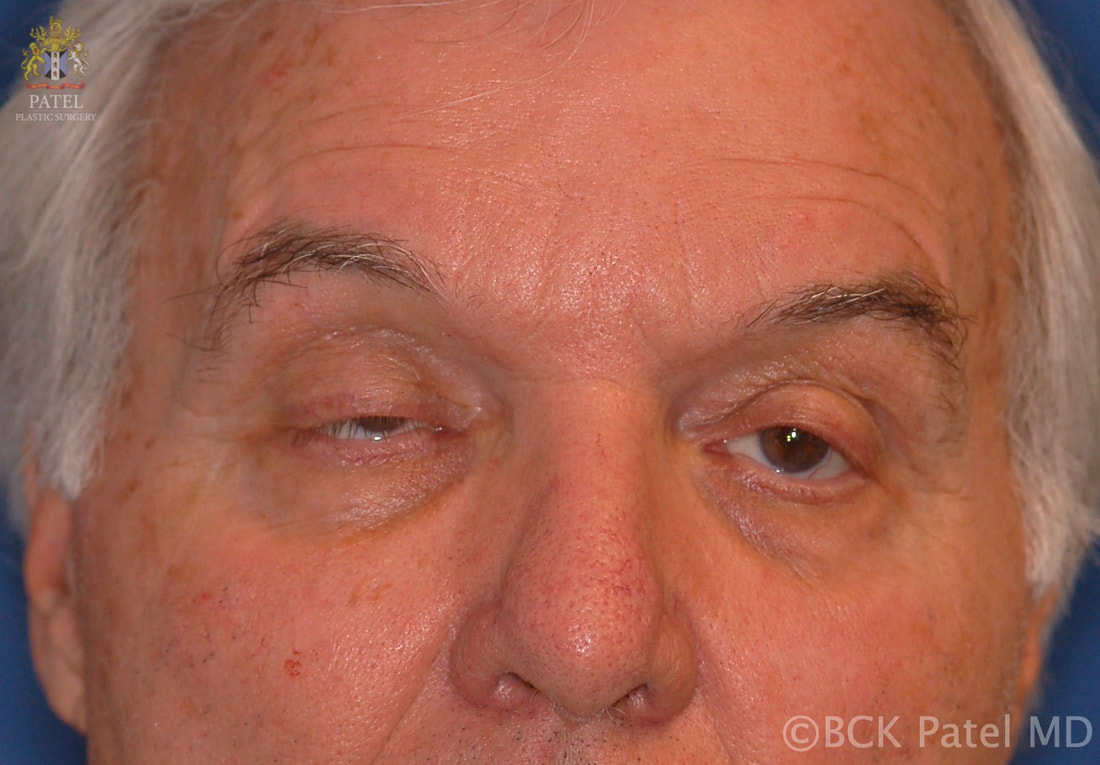 Myasthenia gravis with severe asymmetric ptosis and lower lid retraction with brow overaction by Prof. BCK Patel MD, FRCS