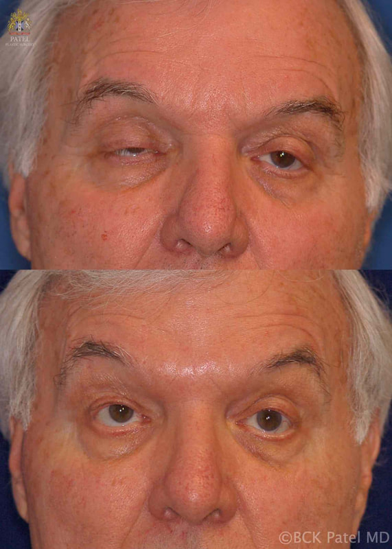 Repair of ptosis with levator advancement in myasthenia gravis. At the end of the day, the upper lids are droopy but much improved. Over time, the lids will need further surgery, sometimes slings by Prof. BCK Patel MD, FRCS