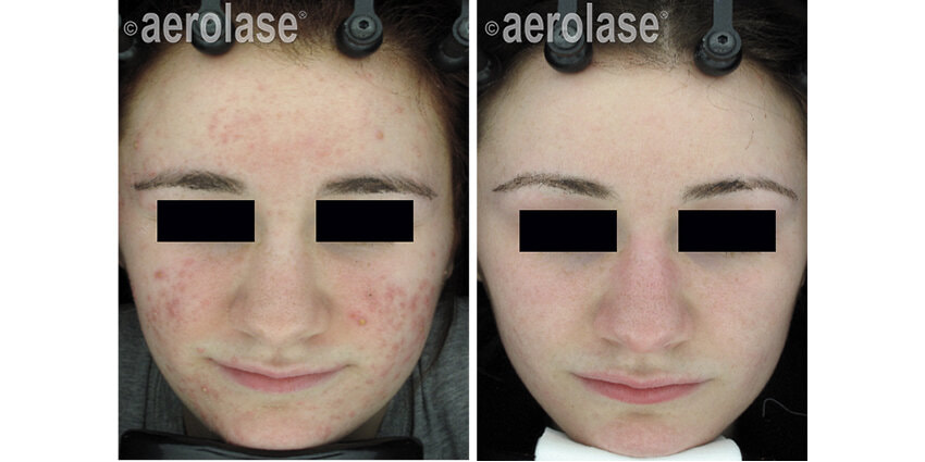 Acne treatment with the Aerolase Neo laser Dr BCK Patel Plastic Surgery Salt Lake CityPicture