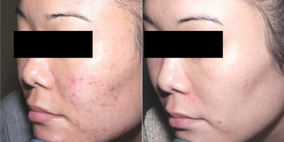 Treatment of acne using Aerolase Laser giving a smoother, firmer skin and improvement in acne by Dr. BCK Patel MD, FRCS