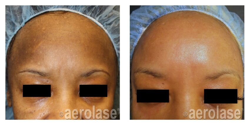 Melasma treatment with the Aerolase Neo BCK Patel MD, FRCSPicture