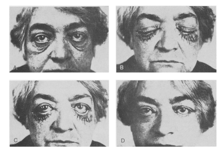 Photos of the first lower blepharoplasty that was ever recorded photographically!