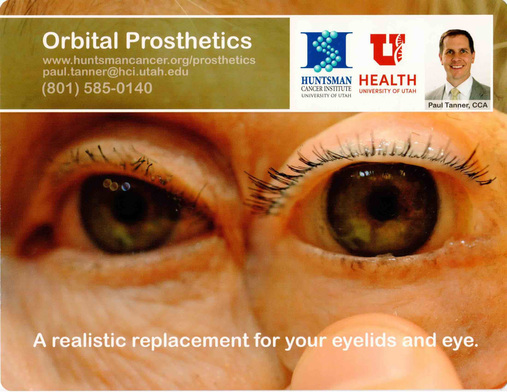 Exenteration prosthesis by Prof BCK Patel, Salt Lake City, Utah