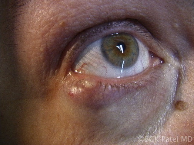 Stye and chalazion in the same patient by Dr. BCK Patel MD, FRCS