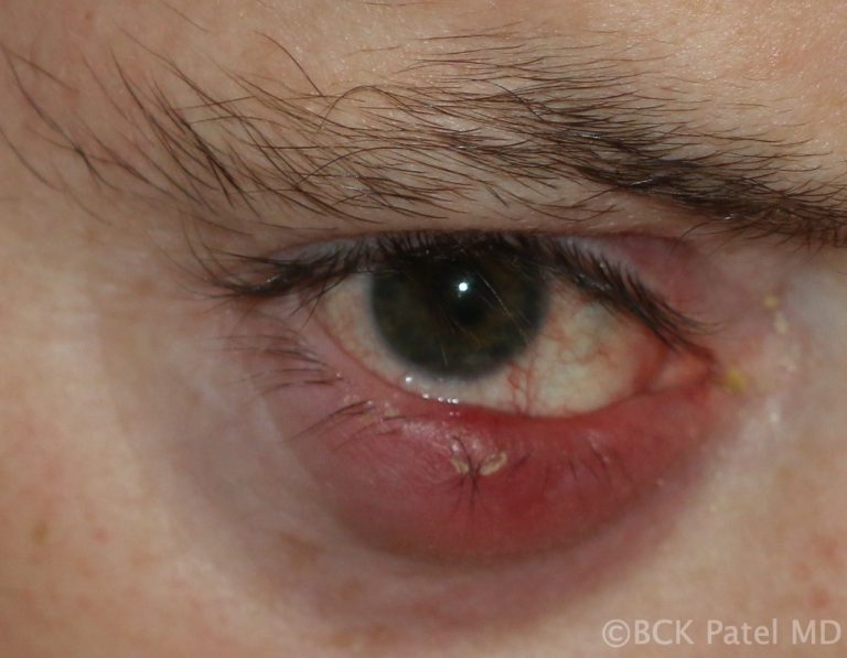 Early cellulitis caused by a chalazion on the lower eyelid by Dr. BCK Patel MD, FRCS