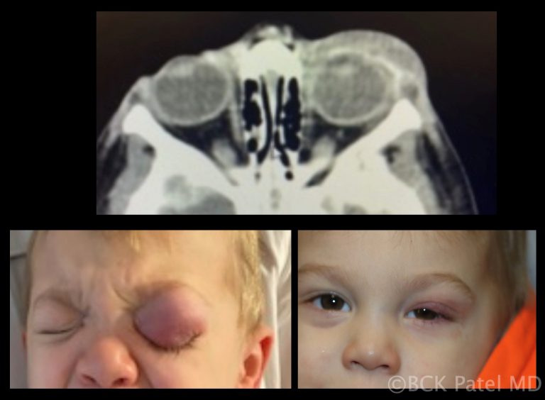Cellulitis in a child caused by chalazia by Dr. BCK Patel MD, FRCS