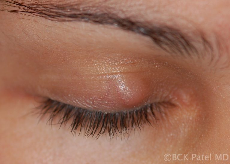 Chronic chalazion illustrated by Dr. BCK Patel MD, FRCS