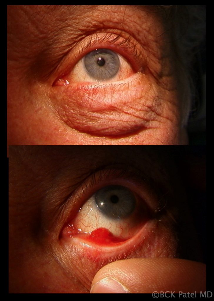 Pyogenic granuloma caused by a posterior chalazion illustrated by Dr. BCK Patel MD, FRCS