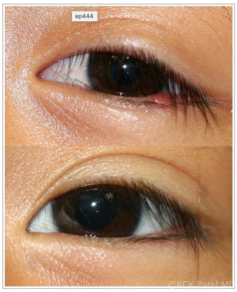 Lower eyelid chalazion shows resolution one month later with conservative treatment. By Dr. BCK Patel MD, FRCS