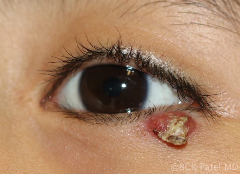 Chronic chalazion erupting through the skin of the eyelid by Dr. BCK Patel MD, FRCS
