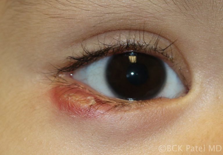 Resolving anterior chalazion illustrated by Dr. BCK Patel MD, FRCS