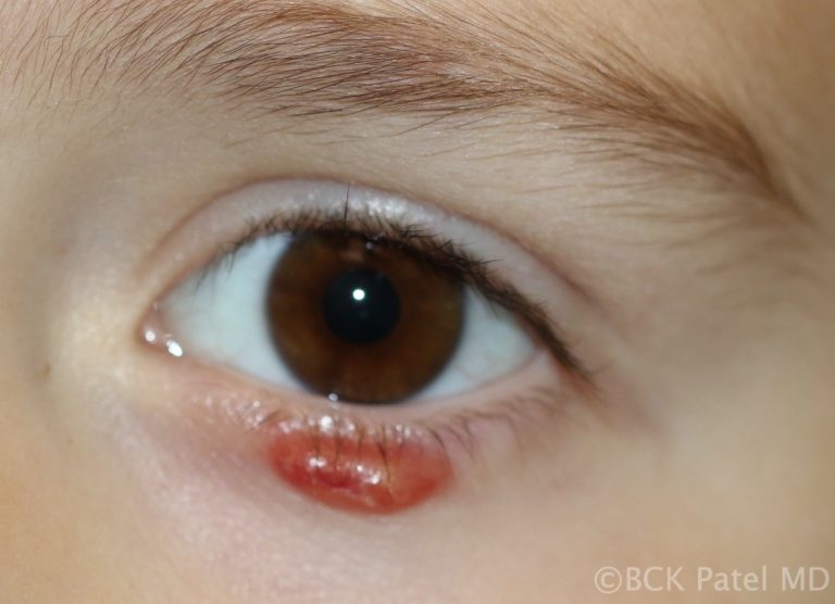 Anterior chalazion in a child illustration by Dr. BCK Patel MD, FRCS