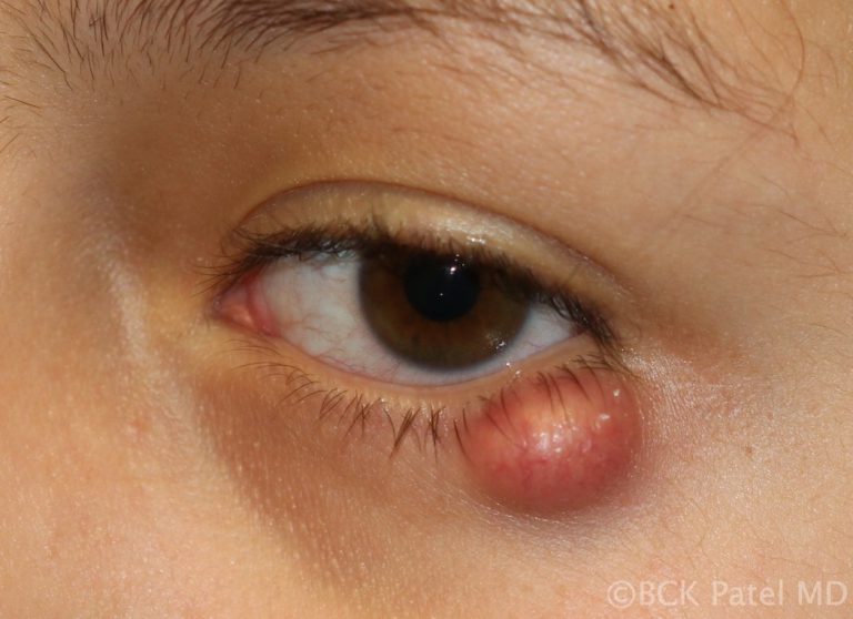 External hordeolum or anterior chalazion illustrated by Dr. BCK Patel MD, FRCS