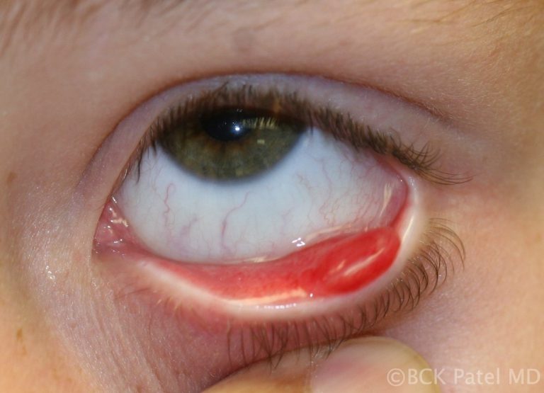 Pyogenic granuloma in the presence of a chalazion by Dr. BCK Patel MD, FRCS