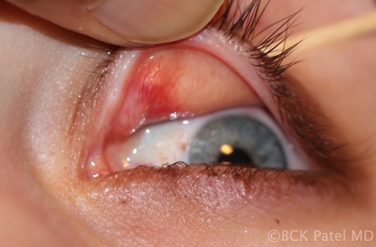 Chalazion of the upper eyelid by Dr. BCK Patel MD, FRCS