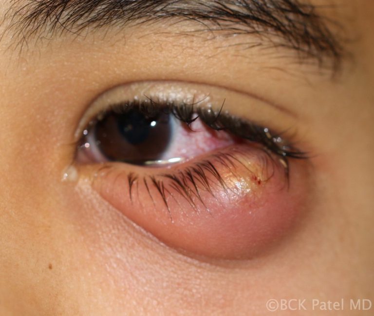 Giant chalazion of the left lower eyelid by Dr. BCK Patel MD, FRCS