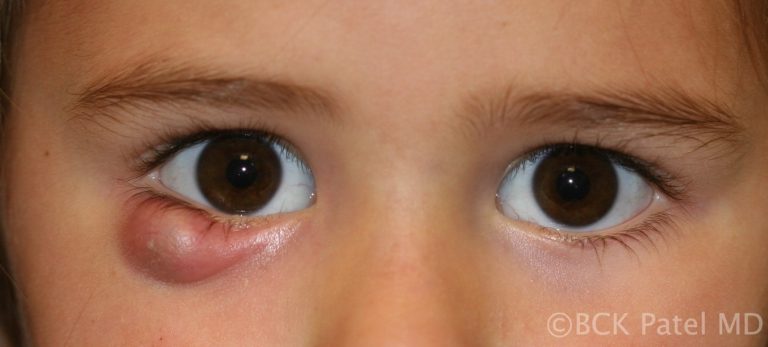Large chalazion in a child