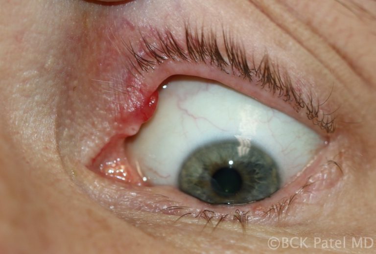 Chronic chalazion close to the upper punctum of the left upper eyelid illustrated by Dr. BCK Patel MD, FRCS