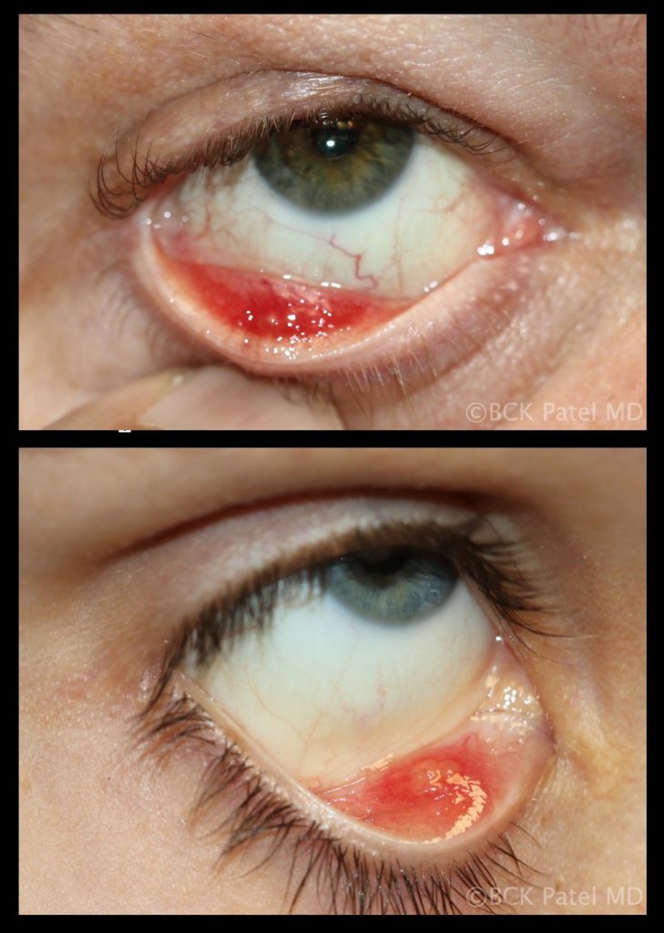 Multiple chalazia affecting the right lower eyelid illustrated by Dr. BCK Patel MD, FRCS