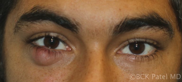 Multiple chalazia affecting all four eyelids by Dr. BCK Patel MD, FRCS