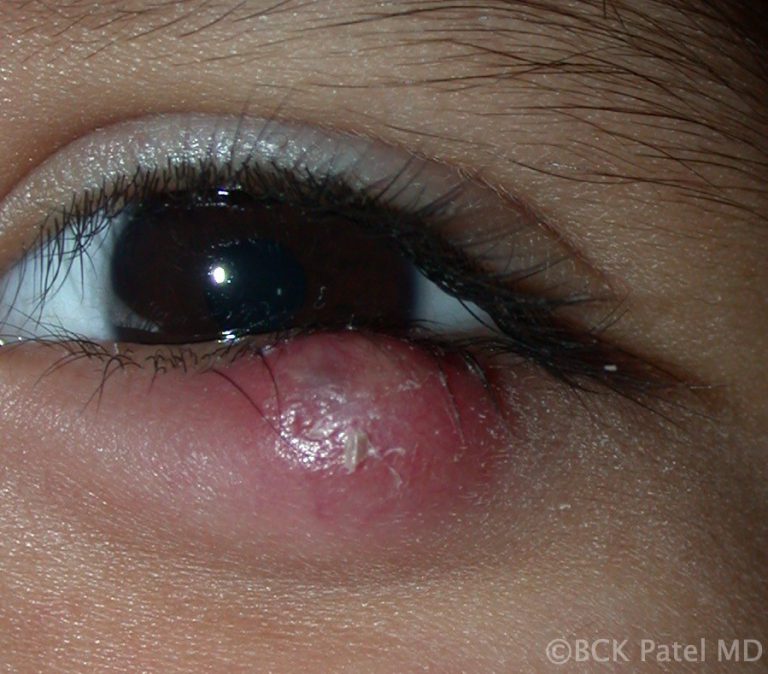 Anterior chalazion or external hordeolum with surrounding erythema and inflammation by Dr. BCK Patel MD, FRCS