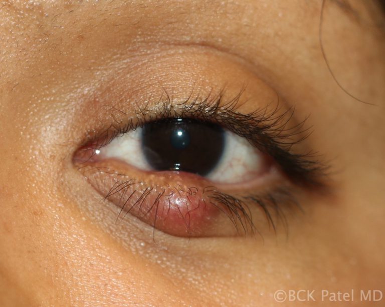 Firm chronic chalazion illustrated by Dr. BCK Patel MD, FRCS