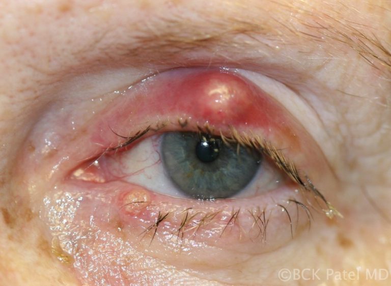 External acutely inflamed hordeolum or chalazion by Dr. BCK Patel MD, FRCS