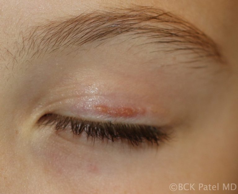 Chronic chalazia in children will often lead to small bumps along the eyelids. Illustrated by Dr. BCK Patel MD, FRCS
